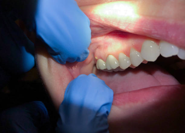 Best Emergency Wisdom Teeth Removal in Woodside, CA